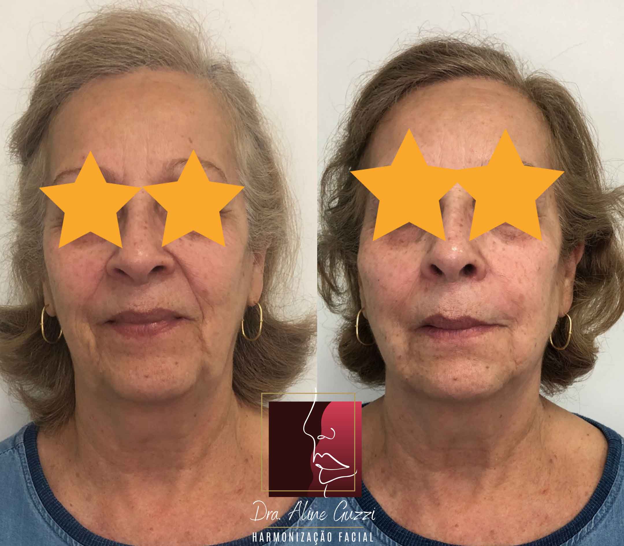 Harmonização Facial - Dra. Aline Guzzi: Caso Clínico de Bioestimulador