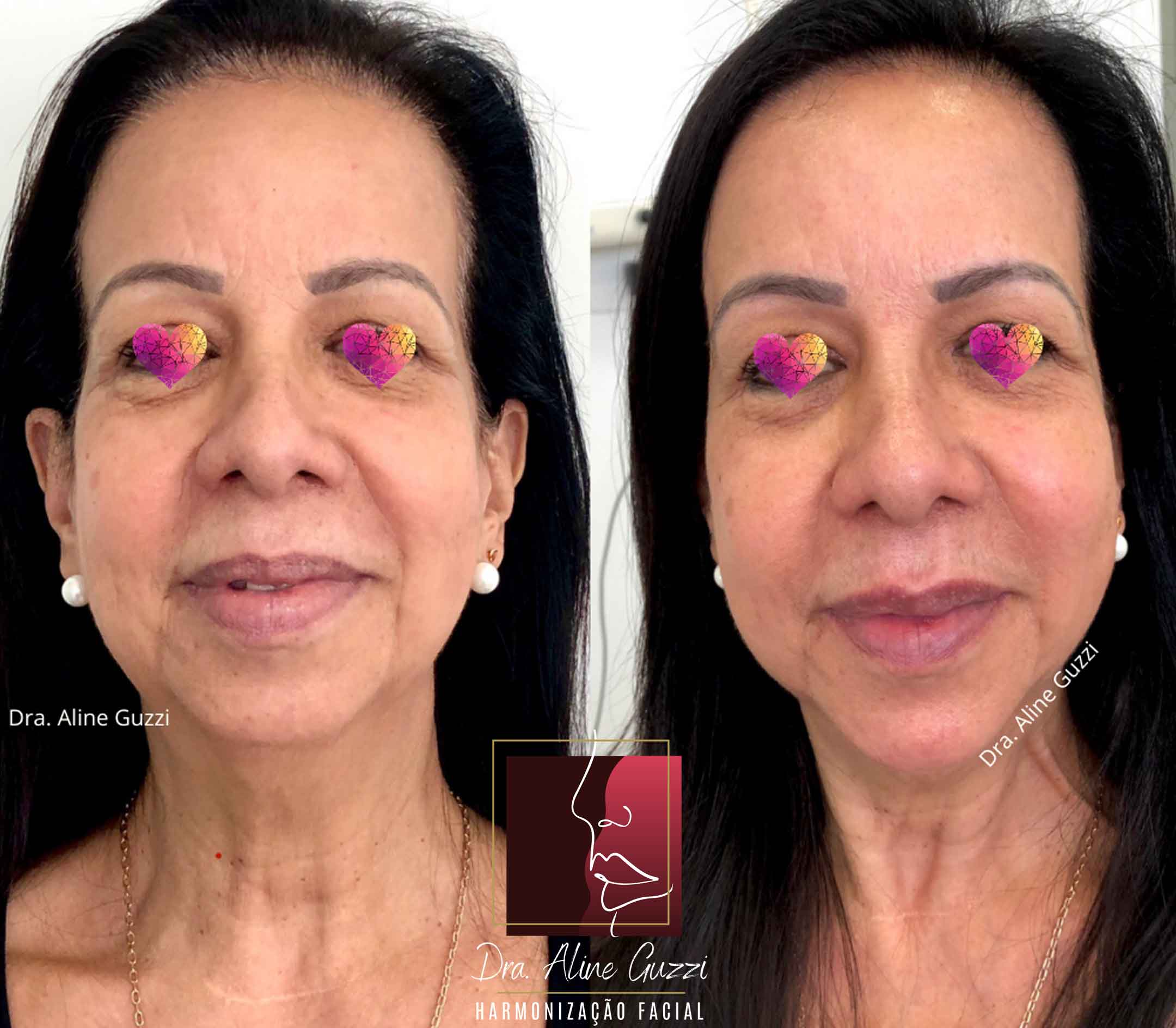 Harmonização Facial - Dra. Aline Guzzi: Caso Clínico de Bioestimulador