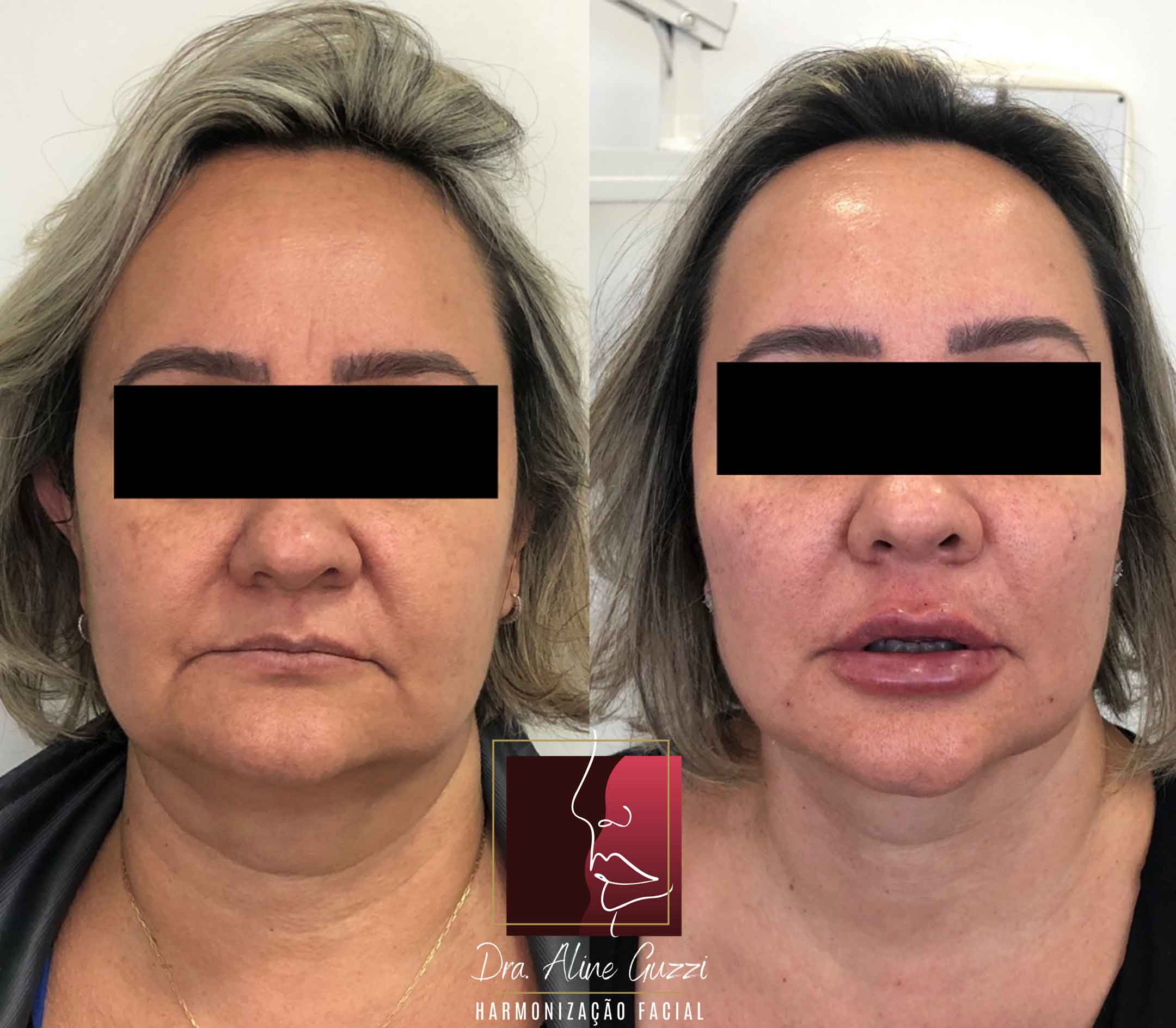 Harmonização Facial - Dra. Aline Guzzi: Caso Clínico de Preenchimento Facial