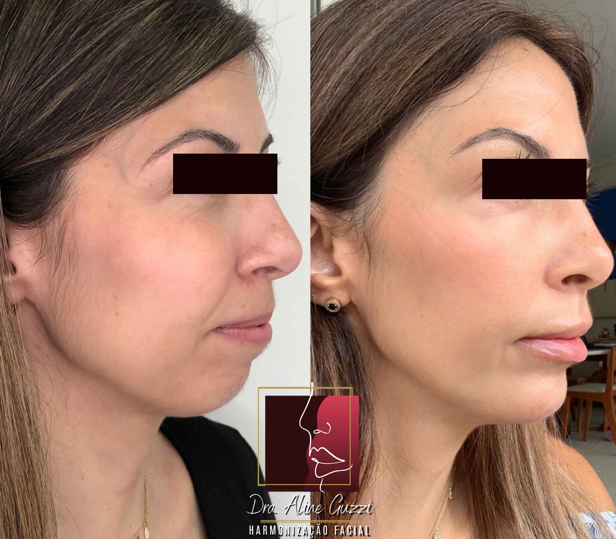 Harmonização Facial - Dra. Aline Guzzi: Caso Clínico de Preenchimento Facial